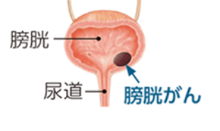 膀胱・尿道・膀胱がんの図