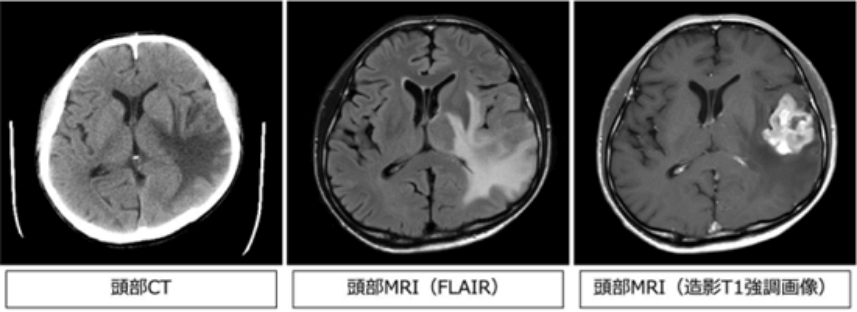頭部CT、頭部MRI（FLAIR）、頭部MRI(造影T1強調画像)