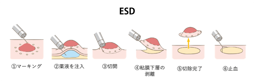 ESD ① マーキング ②薬液を注入 ③切開 ④粘膜下層の剥離 ⑤切除完了 ⑥止血