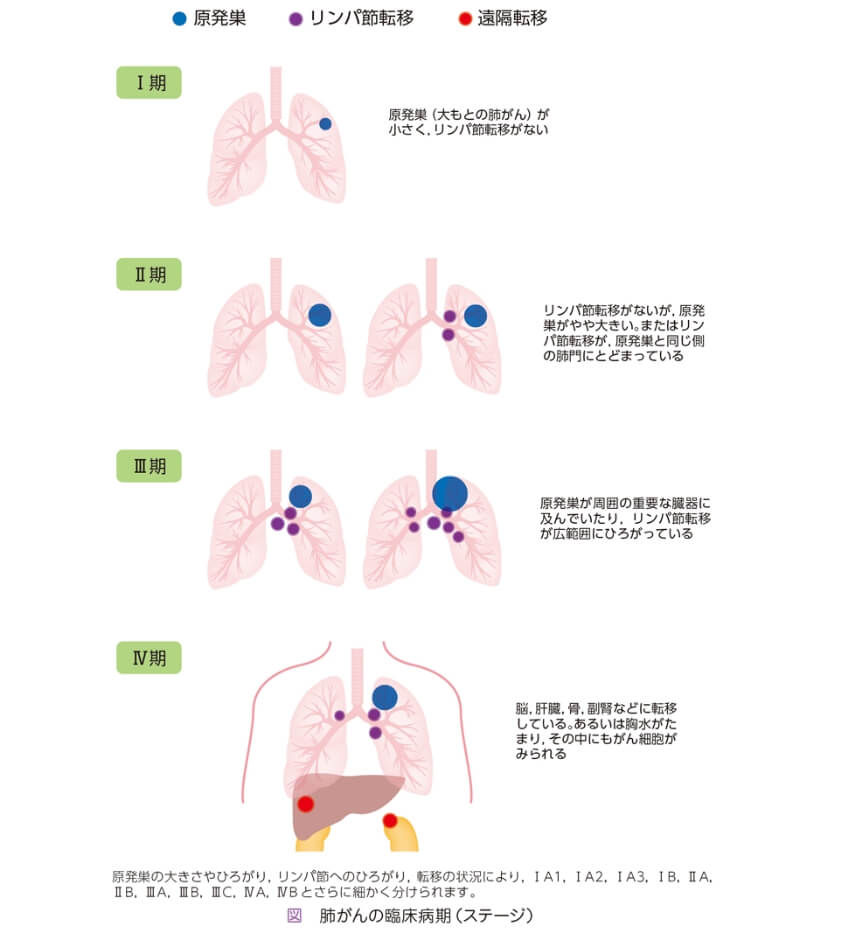 肺がんの臨床病期（ステージ）