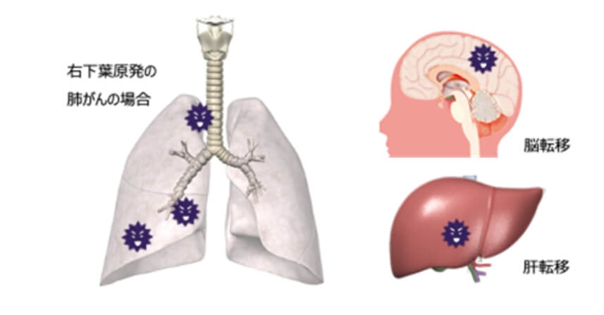 右下葉原発の肺がんの場合 脳転移 肝転移