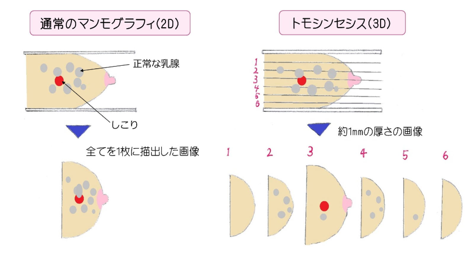 従来のマンモグラフィ（2D）と同じ圧迫で、さまざまな角度から撮影することにより、こまやかな画像を提供できる撮影方法