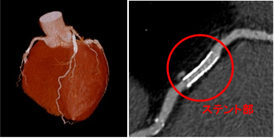 心臓CT　３次元再構成画像