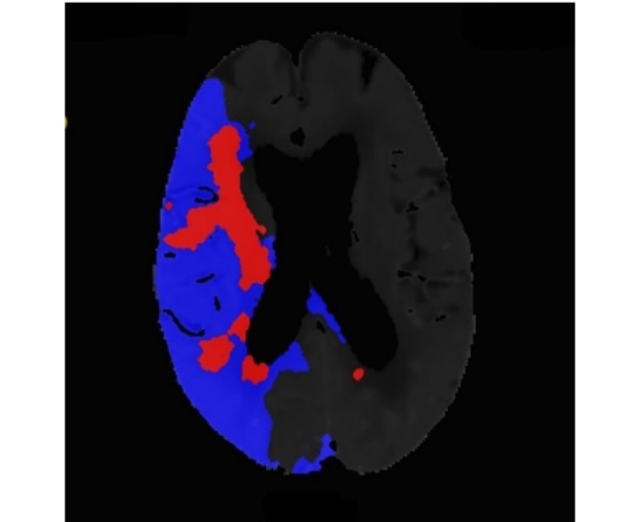 脳梗塞患者のCTPerfusion（灌流）画像